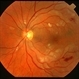 SLE Retinopathy